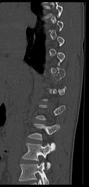 File:Aneurysmal bone cyst T11 (Radiopaedia 29294-29721 Sagittal bone window 52).jpg