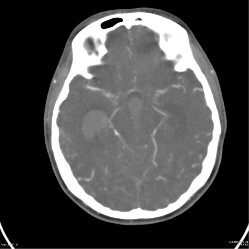 Aneurysmal subarachnoid hemorrhage and Moya Moya disease (Radiopaedia 34306-35593 Axial CT COW 33).jpg