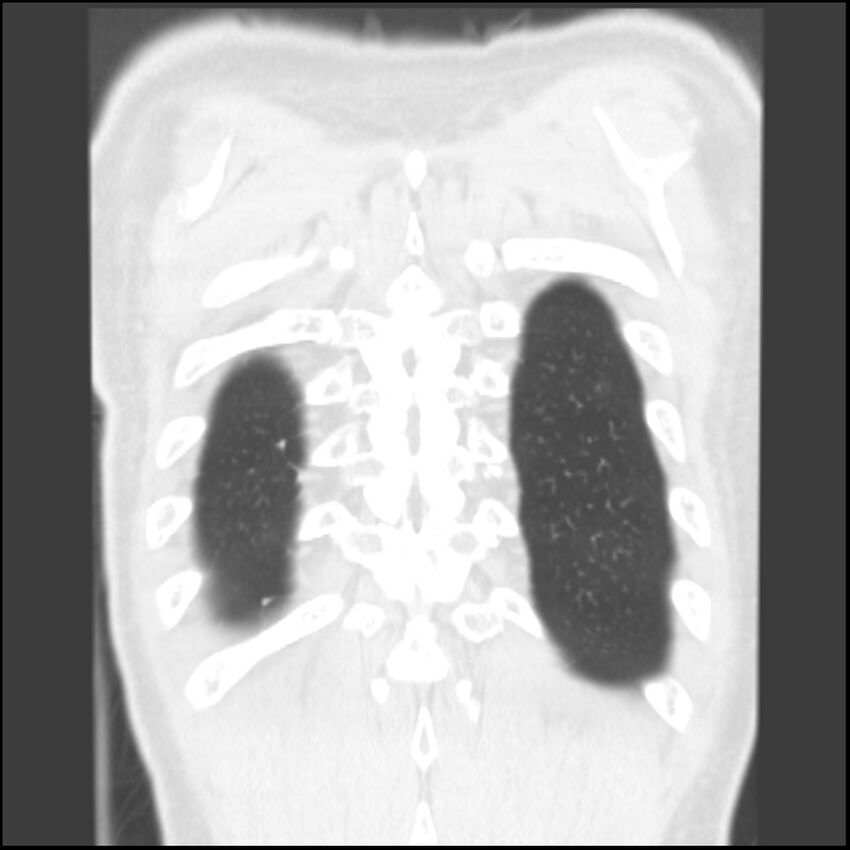Angioinvasive aspergillosis (Radiopaedia 43957-47466 Coronal lung window 6).jpg