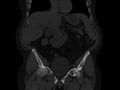 Ankylosing spondylitis (Radiopaedia 44609-48357 Coronal bone window 14).jpg