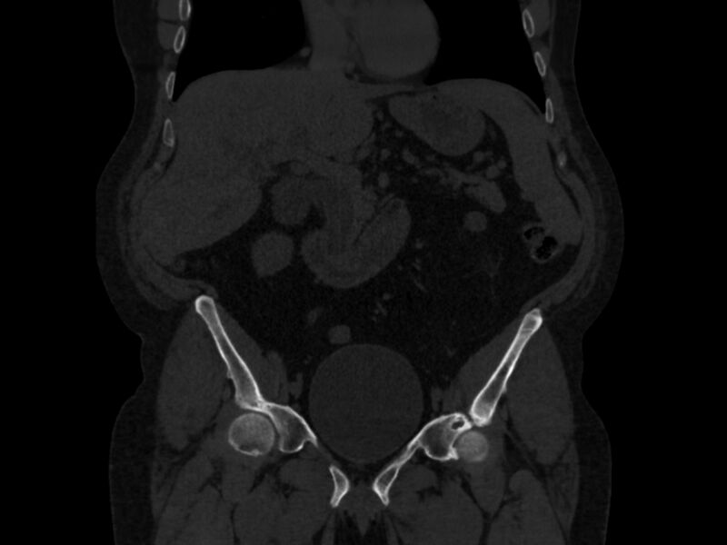 File:Ankylosing spondylitis (Radiopaedia 44609-48357 Coronal bone window 14).jpg