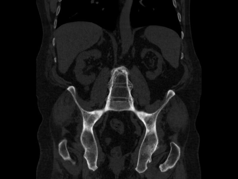 File:Ankylosing spondylitis (Radiopaedia 44609-48357 Coronal bone window 49).jpg