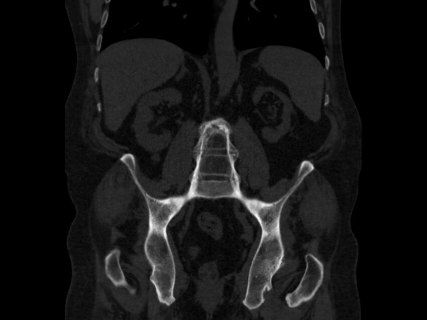 Ankylosing spondylitis (Radiopaedia 44609-48357 Coronal bone window 49).jpg