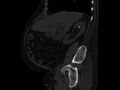 Ankylosing spondylitis (Radiopaedia 44609-48357 Sagittal bone window 32).jpg