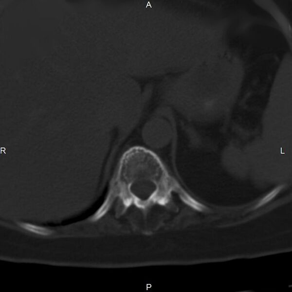 File:Ankylosing spondylitis (Radiopaedia 8748-9556 Axial bone window 11).jpg