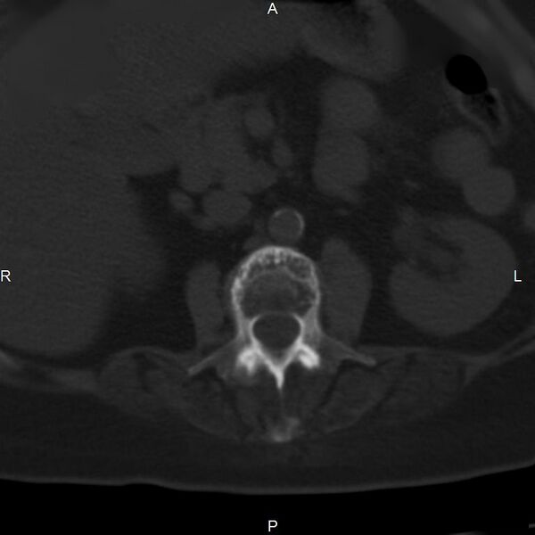 File:Ankylosing spondylitis (Radiopaedia 8748-9556 Axial bone window 26).jpg
