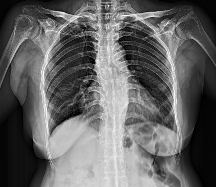 File:Ankylosing spondylitis with dagger sign (Radiopaedia 61271-69171 Frontal 1).PNG