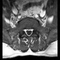 Ankylosing spondylitis with zygapophyseal arthritis (Radiopaedia 38433-40516 Axial T1 1).jpg