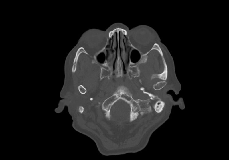 File:Anomalous intracranial venous drainage (Radiopaedia 28161-28418 Axial bone window 2).jpg