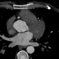 Anomalous origin of the left coronary artery with malignant course (Radiopaedia 77842-90126 C 80).jpeg