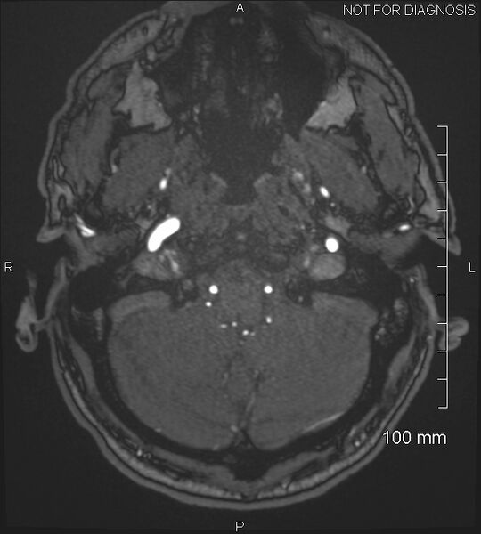 File:Anterior cerebral artery aneurysm (Radiopaedia 80683-94127 Axial MRA 22).jpg