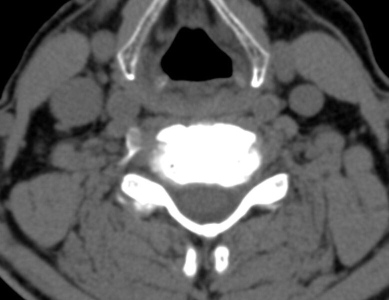 File:Anterior cervical postdiscectomy arthrodesis (Radiopaedia 32678-33646 Axial non-contrast 46).jpg