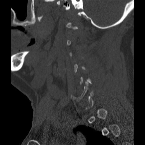 File:Anterior cervical postdiscectomy arthrodesis (Radiopaedia 32678-33646 Sagittal bone window 63).jpg