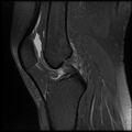 Anterior cruciate ligament tear, Wrisberg rip and bucket-handle tear of medial meniscus (Radiopaedia 75872-87266 Sagittal PD fat sat 13).jpg