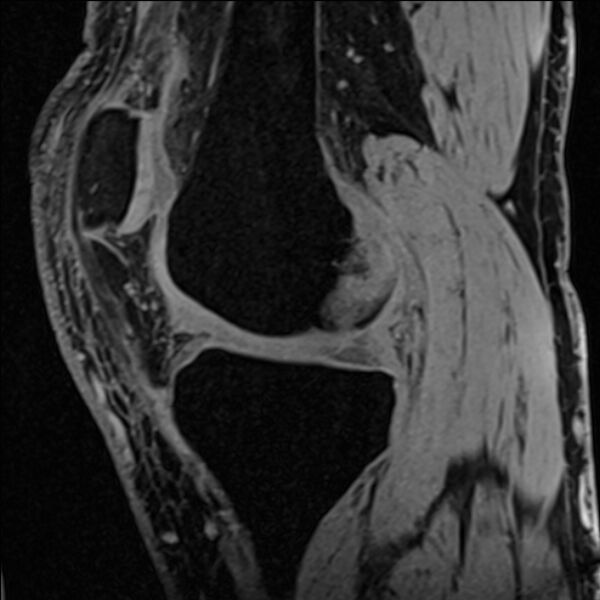 File:Anterior cruciate ligament tear - ramp lesion (Radiopaedia 71883-82322 Sagittal T1 vibe 88).jpg