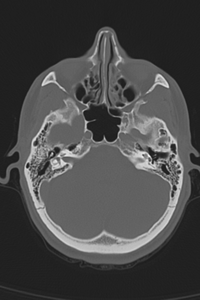 File:Anterior nasal spine fracture (Radiopaedia 46138-50494 Axial bone window 43).png