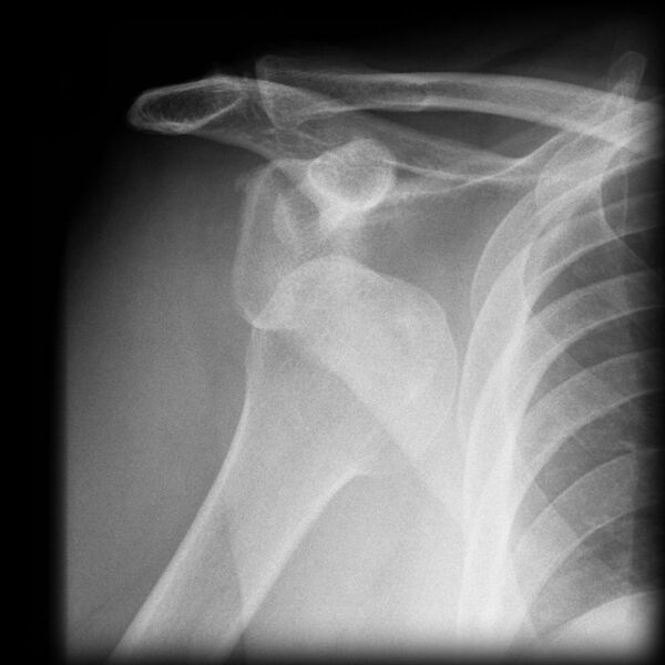 File:Anterior shoulder dislocation (Radiopaedia 2697-6398 Frontal 1).jpg