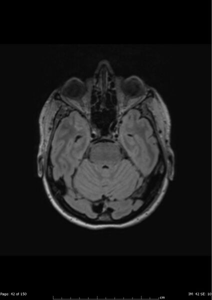 File:Anterior temporal lobe perivascular space (Radiopaedia 40946-43650 Axial FLAIR 3).jpg