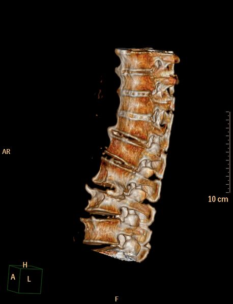 File:Anterior vertebral scalloping (abdominal aortic aneurysm) (Radiopaedia 66744-76067 A 2).jpg