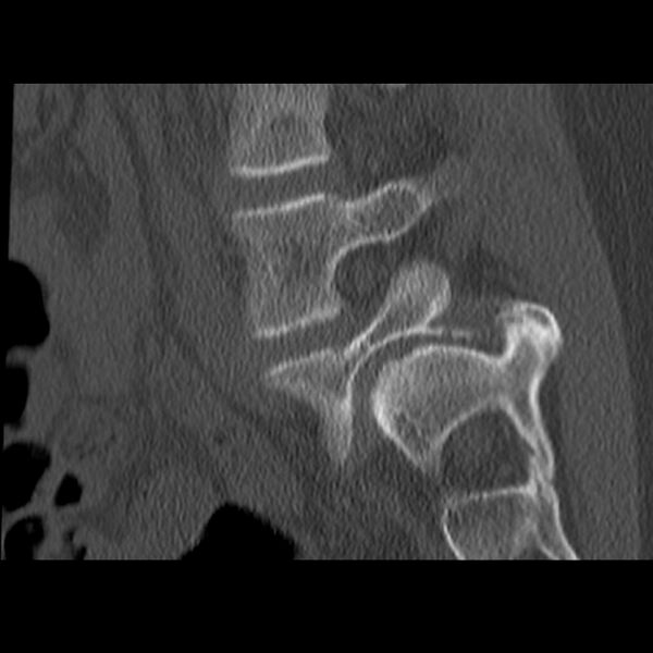 File:Anterolisthesis (Radiopaedia 22226-22263 Sagittal bone window 17).jpg