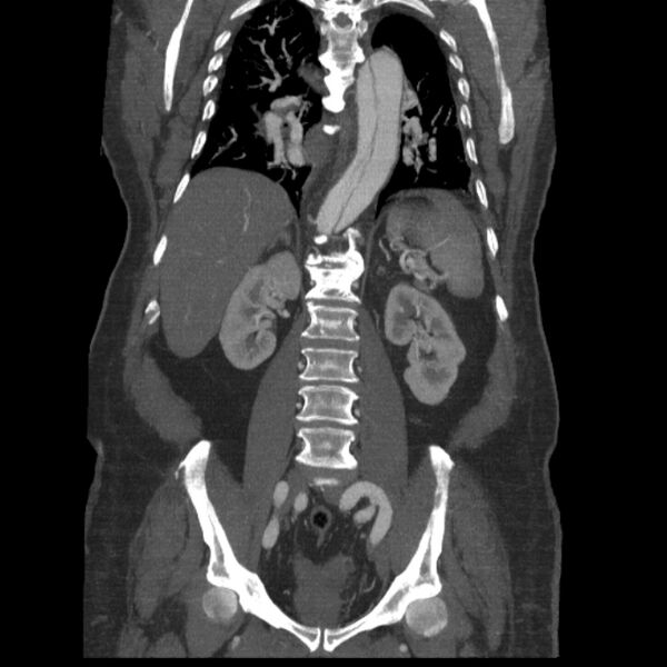 File:Aortic dissection (Radiopaedia 28802-29105 B 25).jpg
