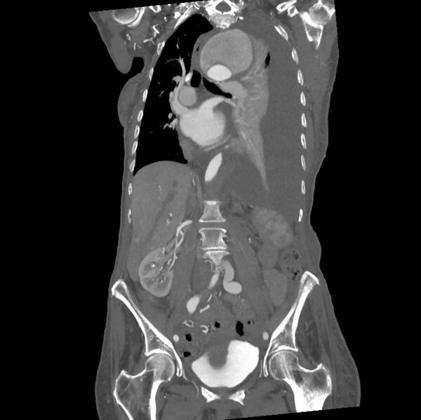 File:Aortic dissection (Radiopaedia 68763-78691 B 20).jpeg