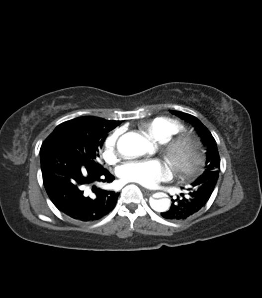 File:Aortic dissection with renal ischemia (Radiopaedia 76573-88338 A 39).jpg