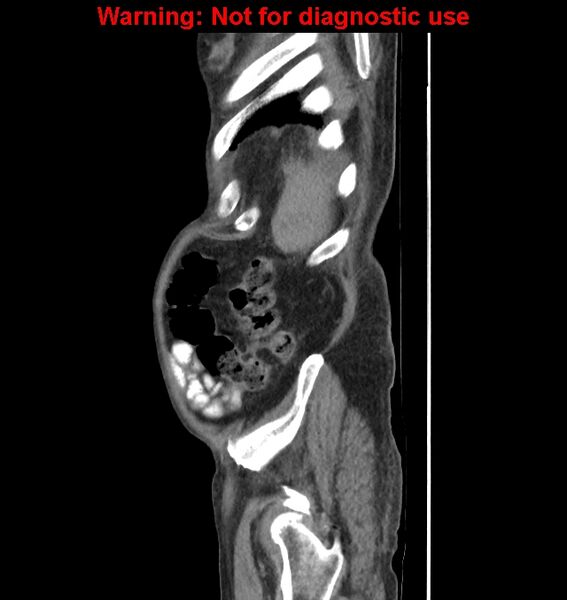 File:Aortic graft infection (Radiopaedia 44979-48907 C 10).jpg