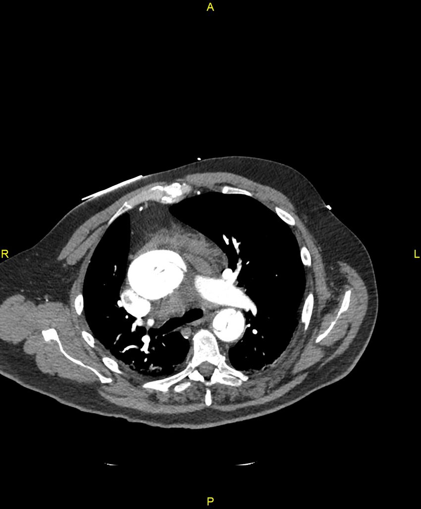 Aortic rupture (Radiopaedia 88822-105594 B 93).jpg
