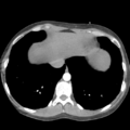 Aortic valve non-coronary cusp thrombus (Radiopaedia 55661-62189 B 41).png