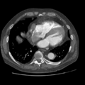 Aorto-coronary bypass graft aneurysms (Radiopaedia 40562-43157 A 86).png