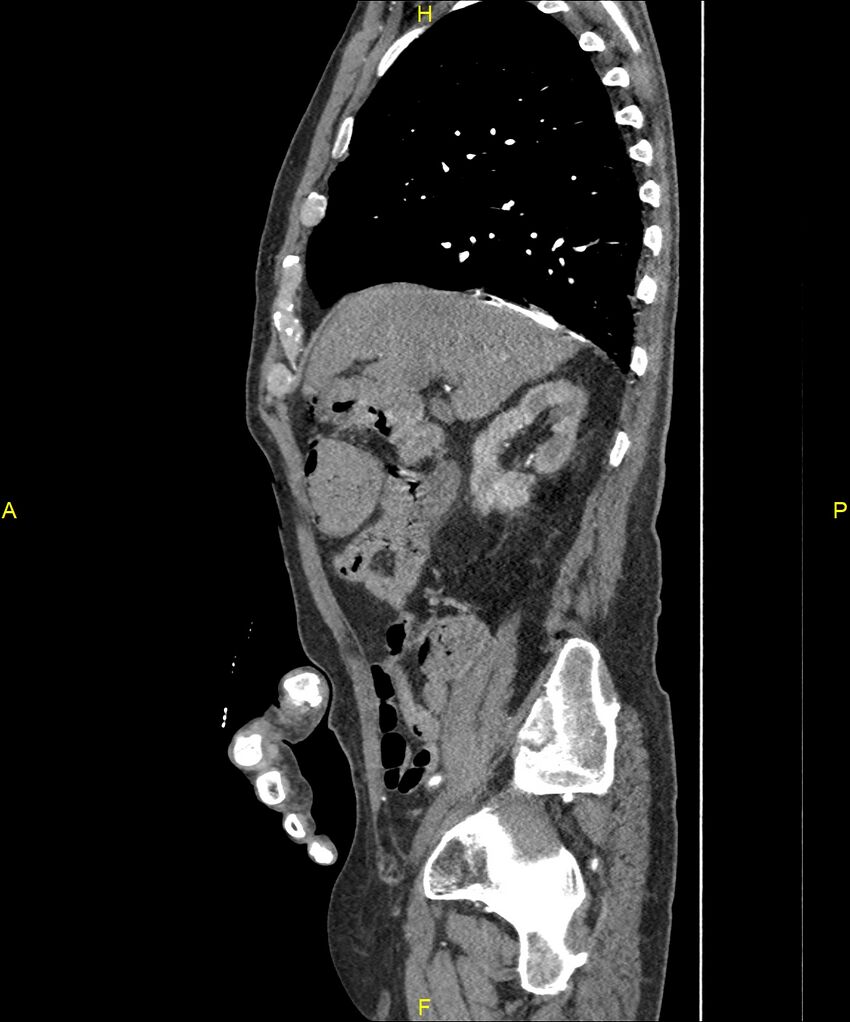 Aortoenteric fistula (Radiopaedia 84308-99603 C 110).jpg