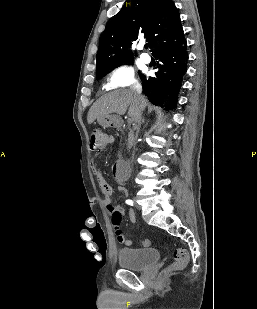 Aortoenteric fistula (Radiopaedia 84308-99603 C 148).jpg