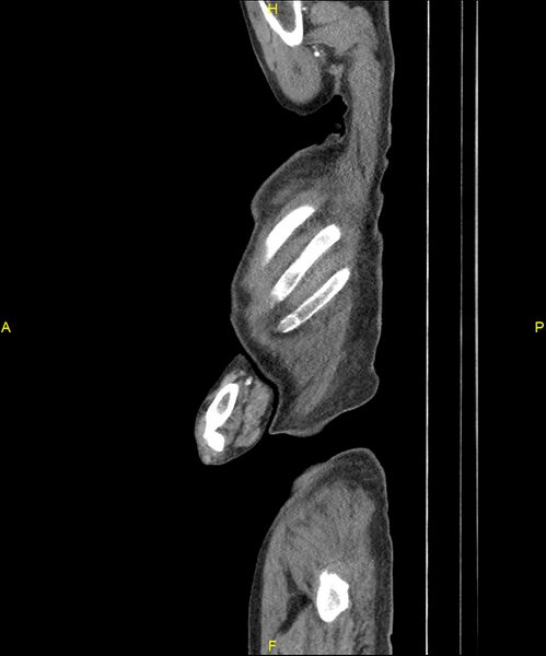 File:Aortoenteric fistula (Radiopaedia 84308-99603 C 16).jpg