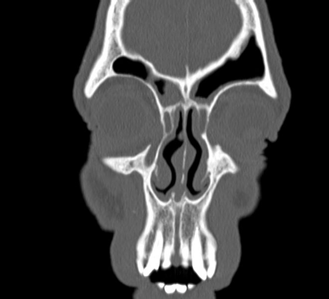 File:Aplastic maxillary sinuses (Radiopaedia 60030-67561 Coronal non-contrast 9).jpg