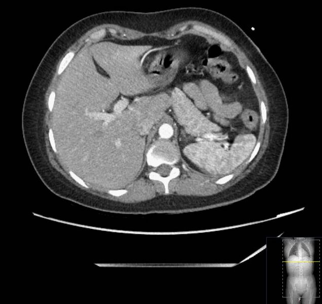 File:Appendicitis (CT angiogram) (Radiopaedia 154713-127660 Axial 155).jpg