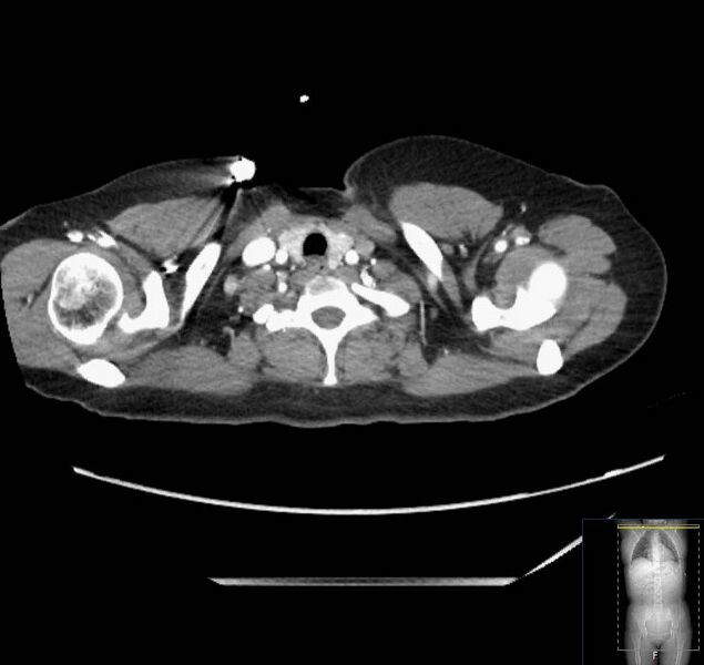 File:Appendicitis (CT angiogram) (Radiopaedia 154713-127660 Axial 243).jpg