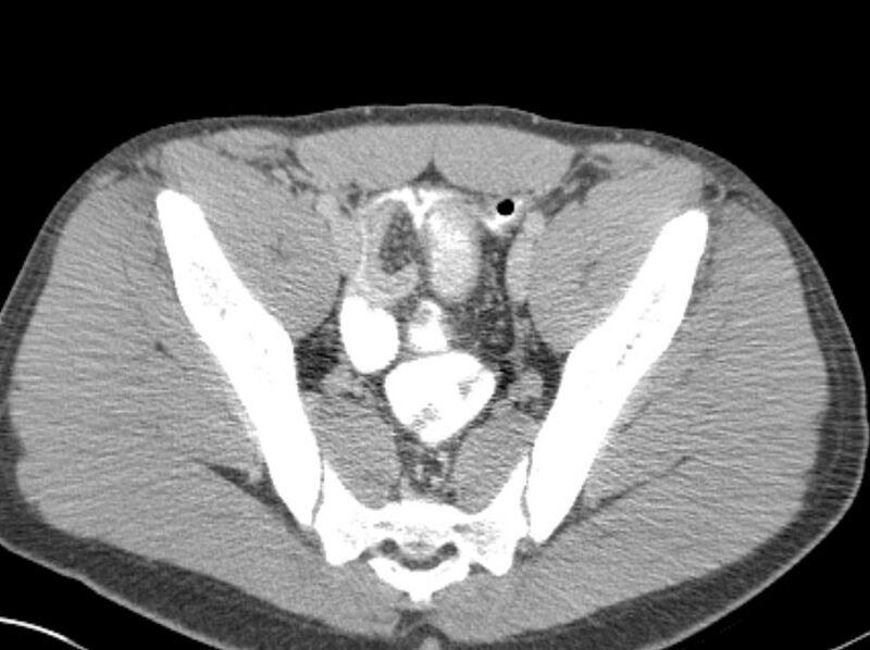 File:Appendicitis and incidental foregut duplication cyst (Radiopaedia 52962-58916 A 83).jpg