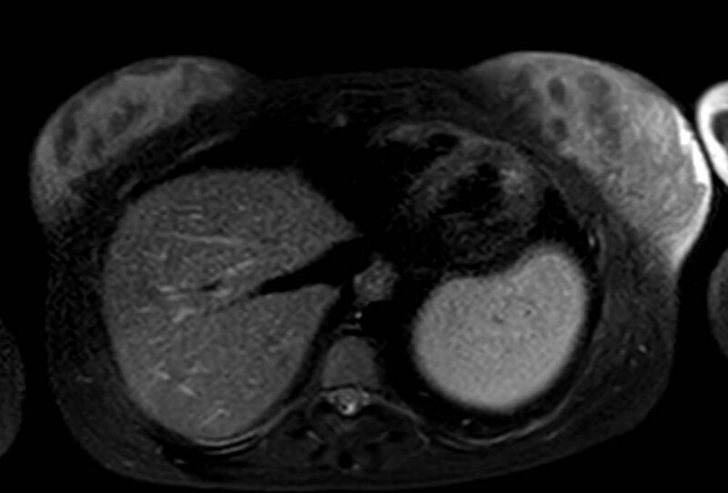 File:Appendicitis in gravida (MRI) (Radiopaedia 89433-106395 Axial T2 SPAIR 7).jpg