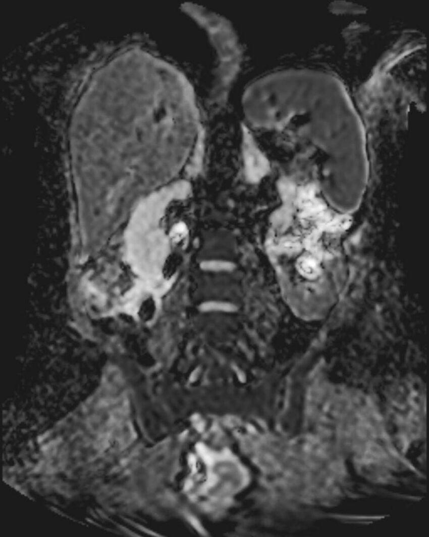 Appendicitis in gravida (MRI) (Radiopaedia 89433-106395 Coronal ADC 37).jpg