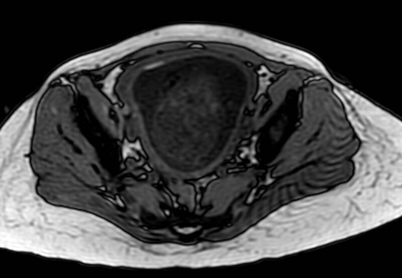 File:Appendicitis in gravida (MRI) (Radiopaedia 89433-106395 D 58).jpg