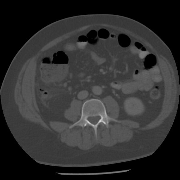 File:Appendicitis with perforation (Radiopaedia 35790-37342 Axial bone window 28).jpg