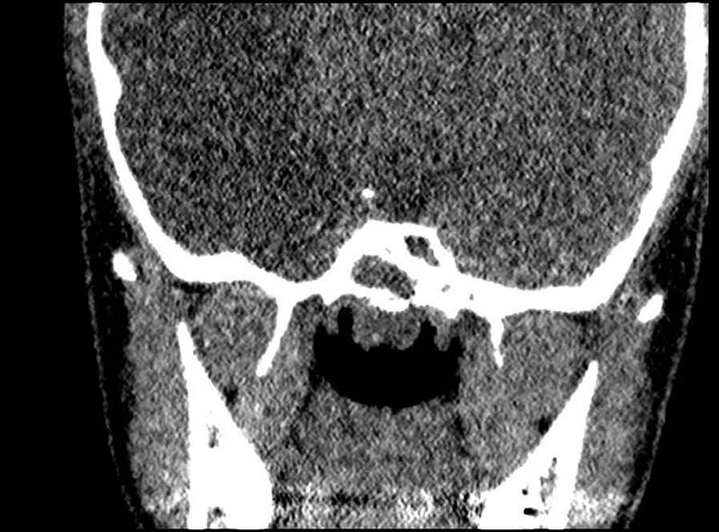 File:Arachnoid cyst- extremely large (Radiopaedia 68741-78450 Coronal bone window 13).jpg