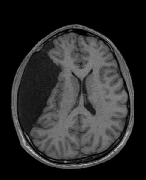File:Arachnoid cyst- extremely large (Radiopaedia 68741-78451 Axial T1 47).jpg