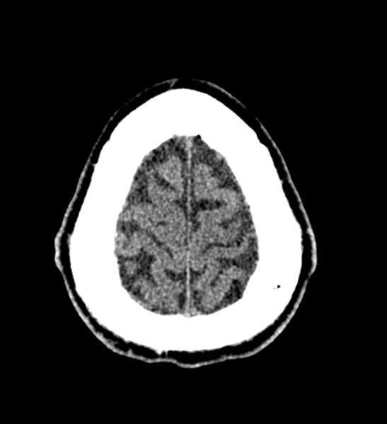 File:Arachnoid cyst of the ambient cistern (Radiopaedia 81301-94986 Axial non-contrast 64).jpg