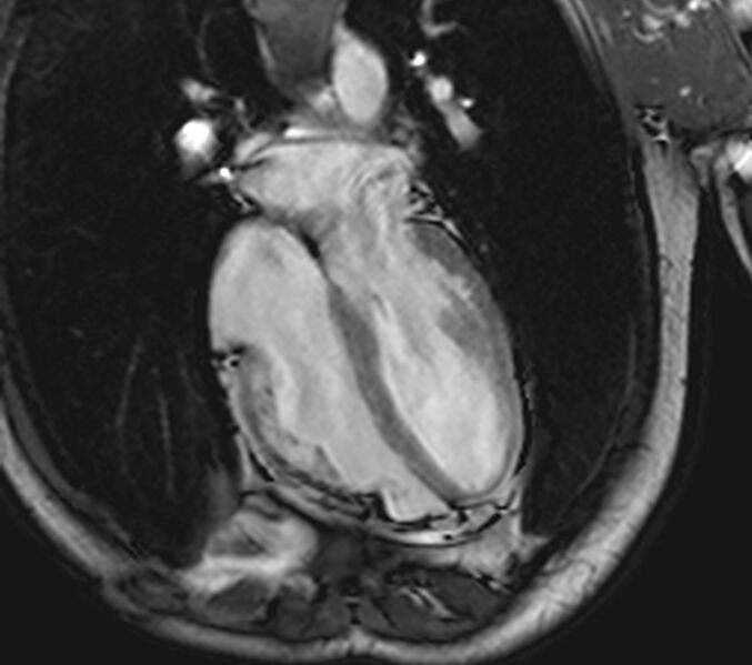 File:Arrhythmogenic right ventricular cardiomyopathy (Radiopaedia 39806-42237 D 58).jpg