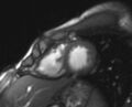Arrhythmogenic right ventricular cardiomyopathy (Radiopaedia 69564-79464 short axis cine 64).jpg