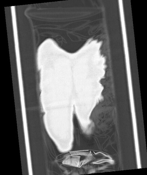 File:Arrow injury to the chest (Radiopaedia 85367-100975 Coronal lung window 125).jpg