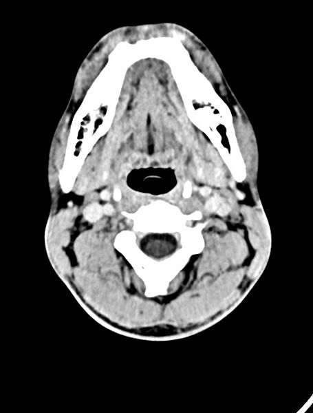 File:Arrow injury to the face (Radiopaedia 73267-84011 Axial C+ delayed 17).jpg