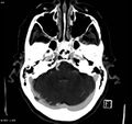 Arteriovenous malformation - cerebral (Radiopaedia 8172-14682 A 3).jpg